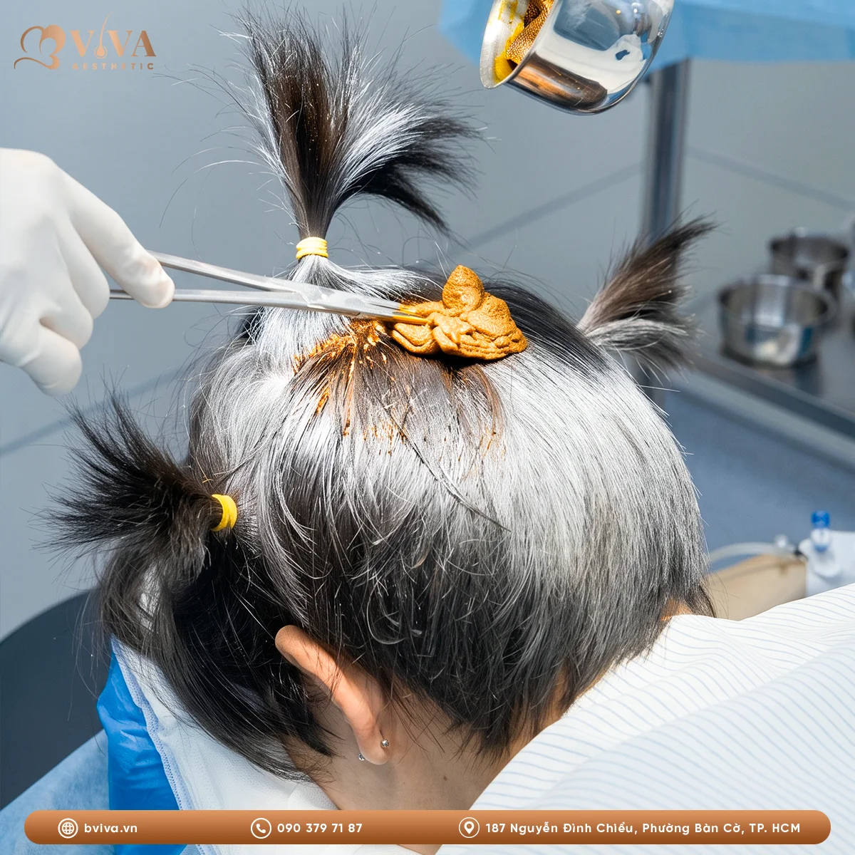 cấy tóc DHI tại BVIVA Aesthetic