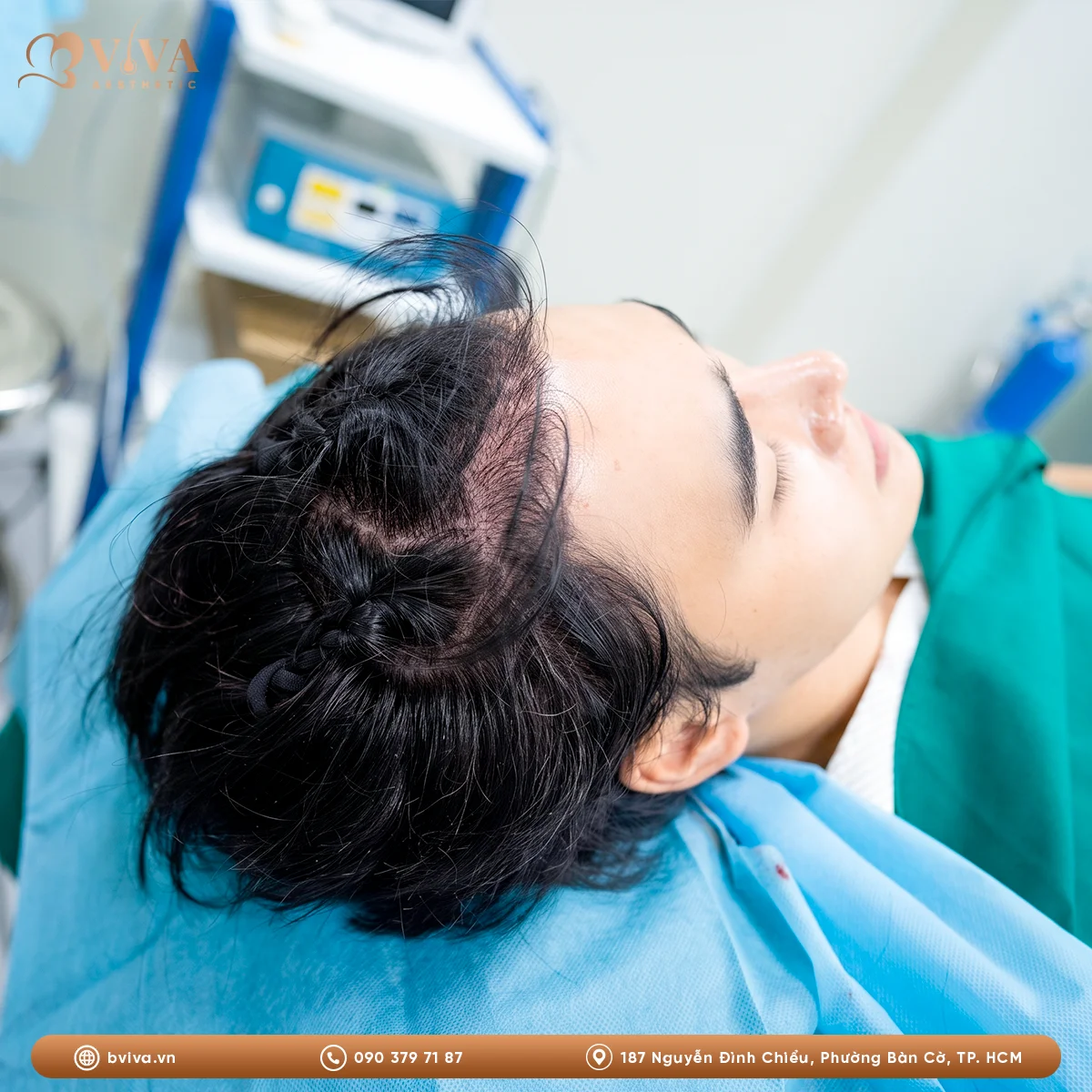 cấy tóc DHI tại BVIVA Aesthetic