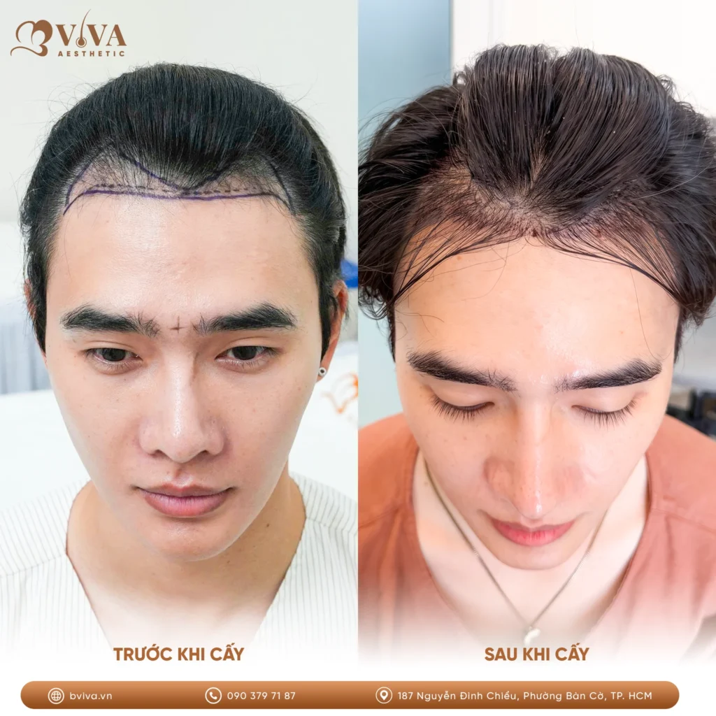 cấy tóc DHI tại BVIVA Aesthetic