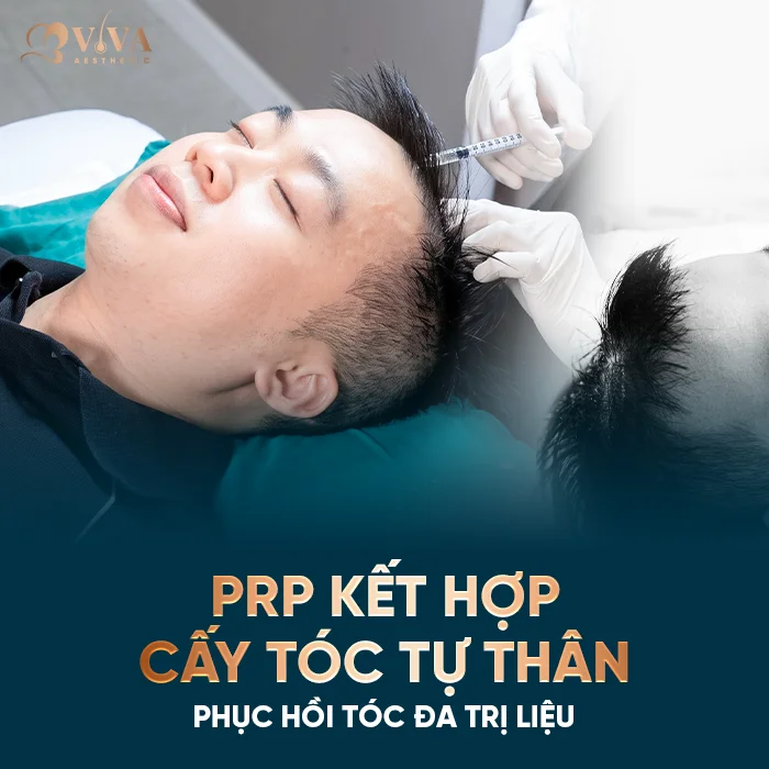 prp kết hợp cấy tóc tự thân