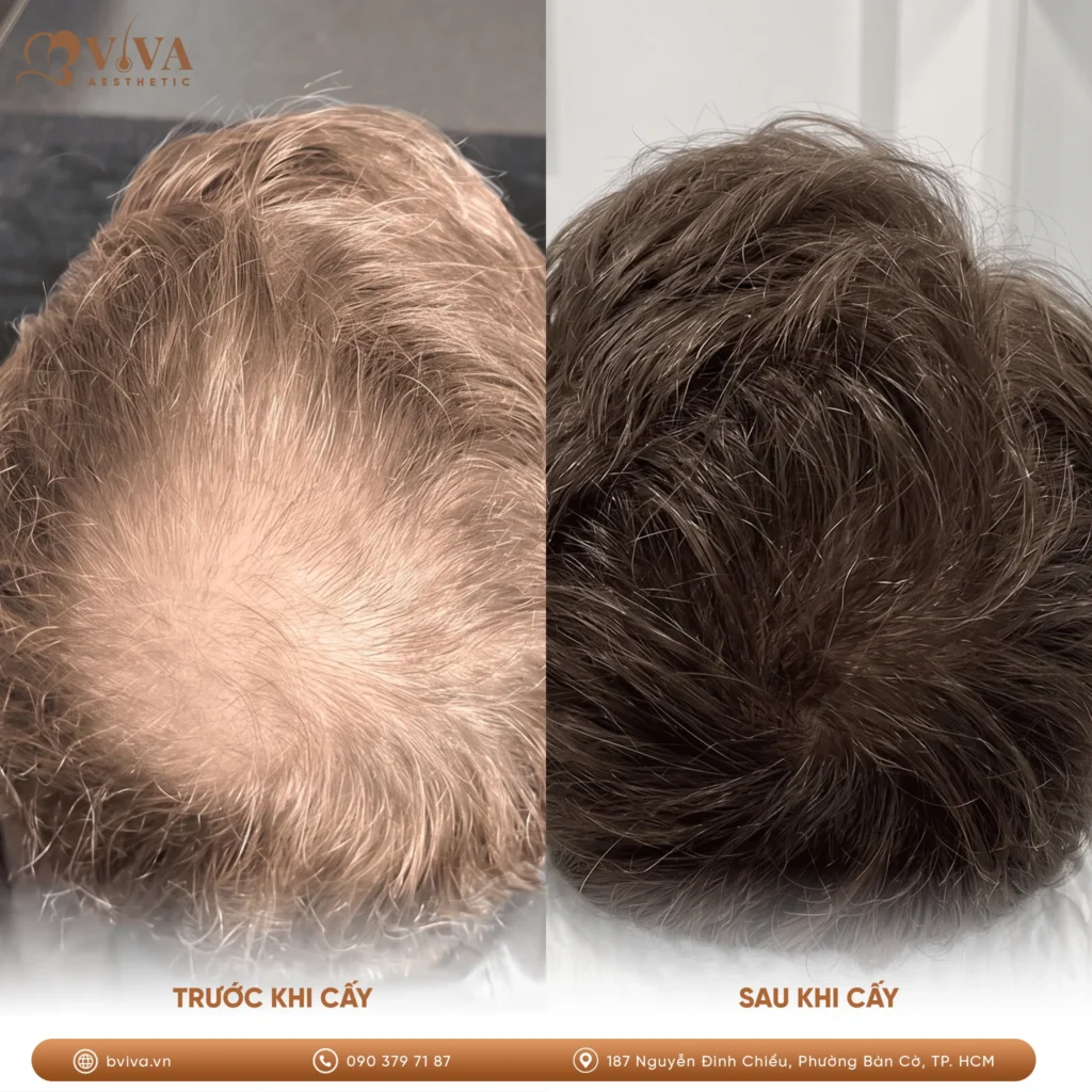 prp kết hợp cấy tóc tự thân