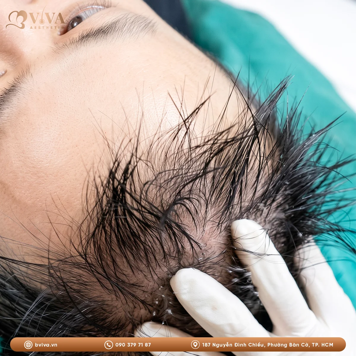 prp kết hợp cấy tóc tự thân