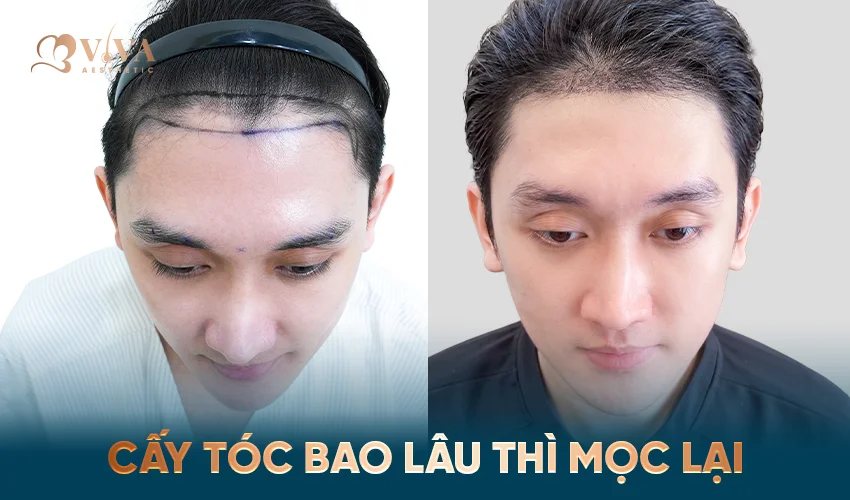 cấy tóc bao lâu thì mọc lại