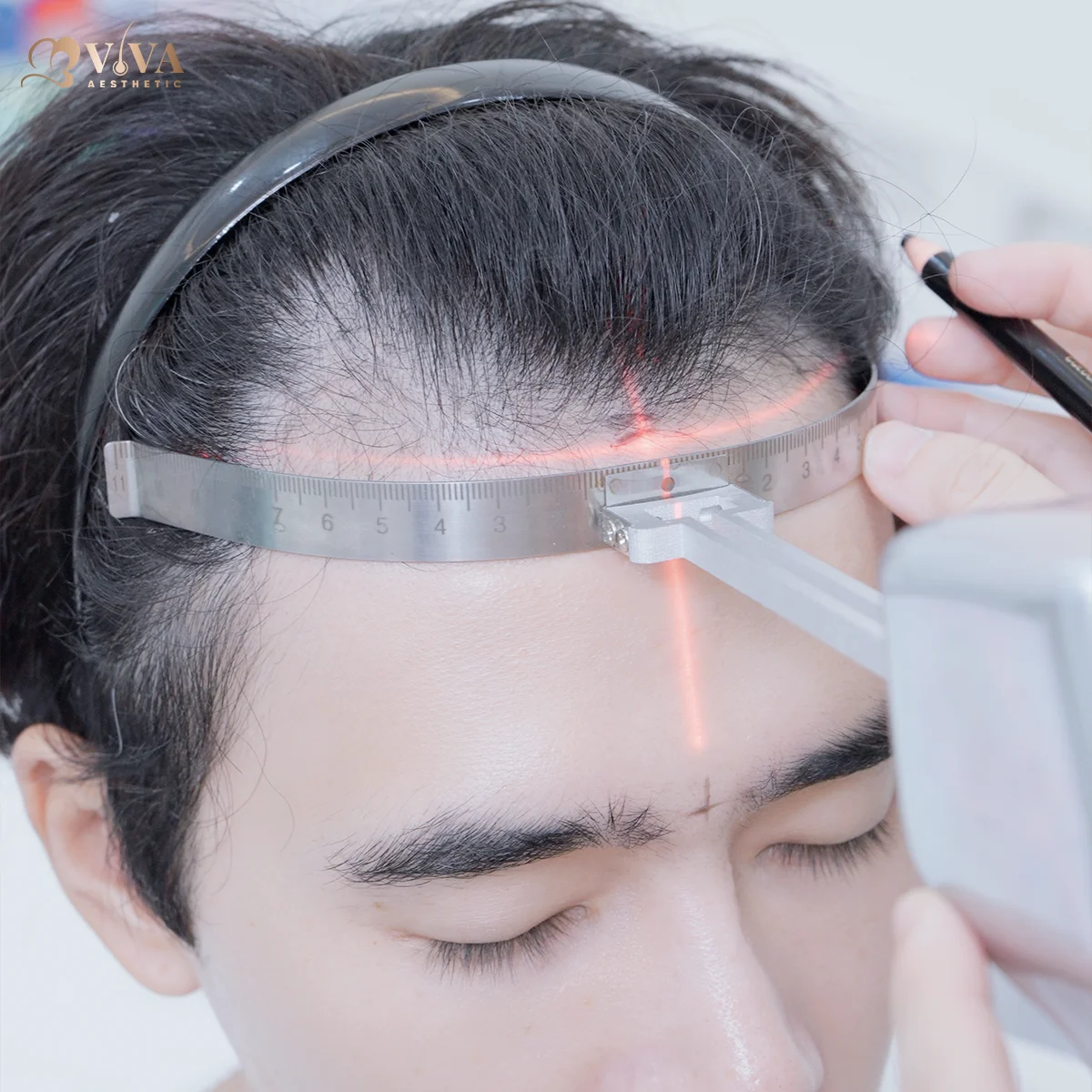 cấy tóc nang dài tại bviva aesthetic