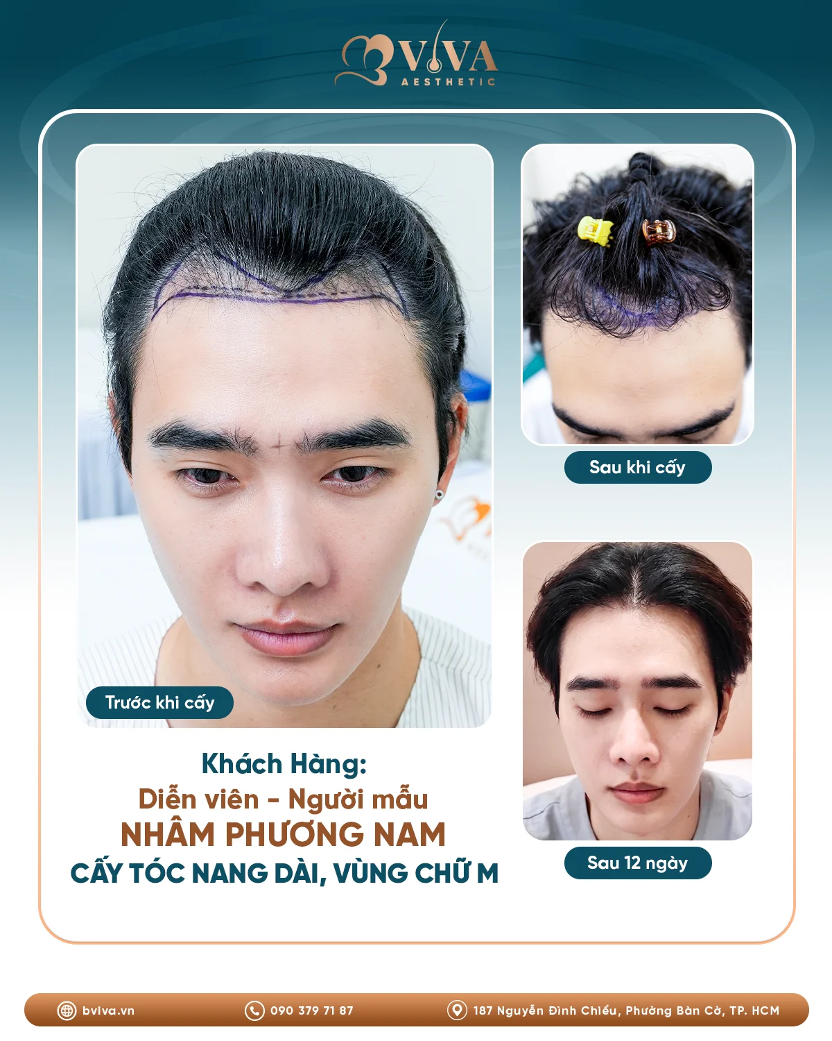 cấy tóc nang dài tại bviva aesthetic