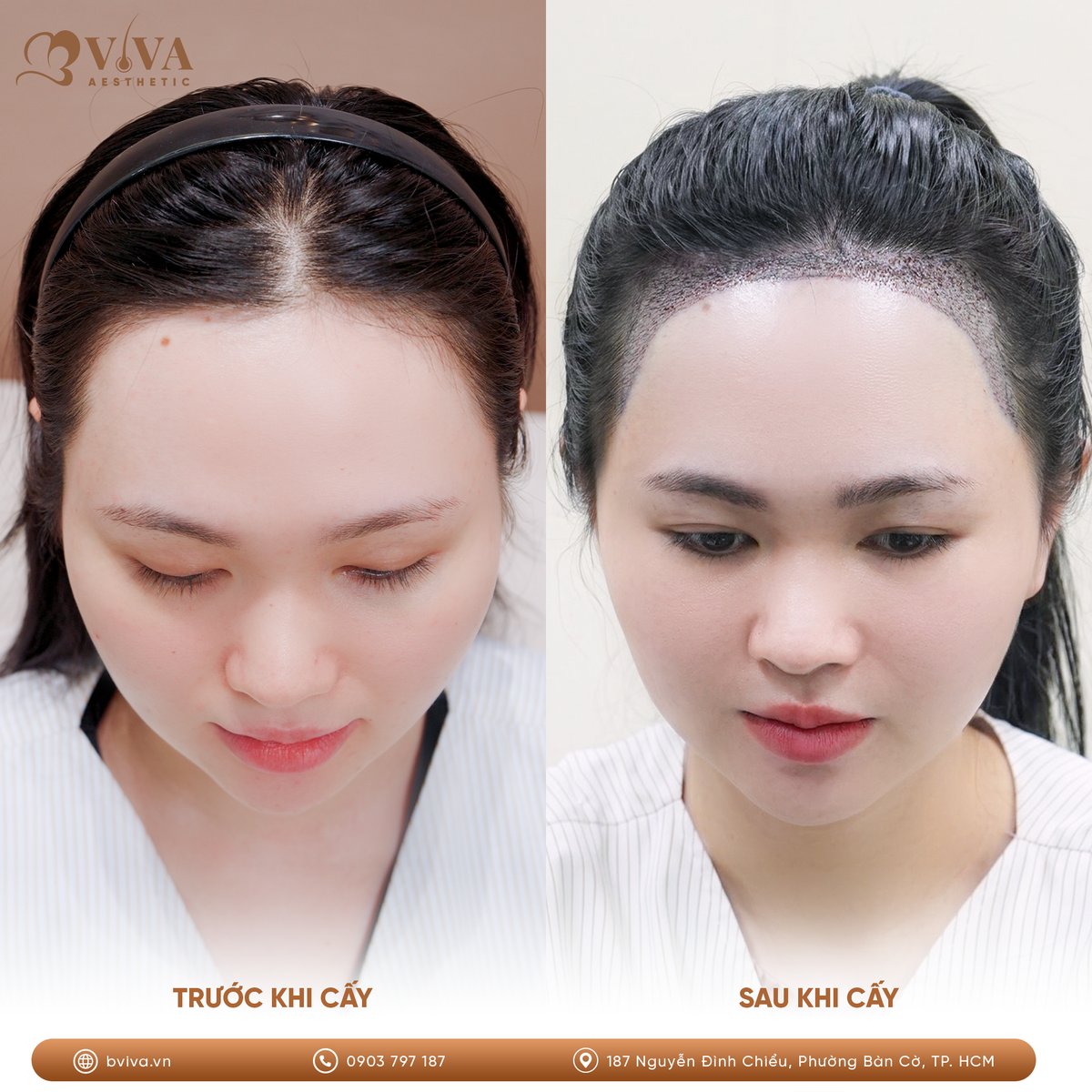Kết quả trước và sau khi cấy tóc tự thân tại BVIVA Aesthetic
