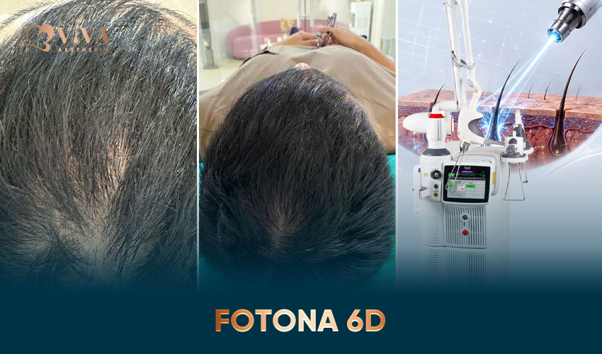 fotona 6d