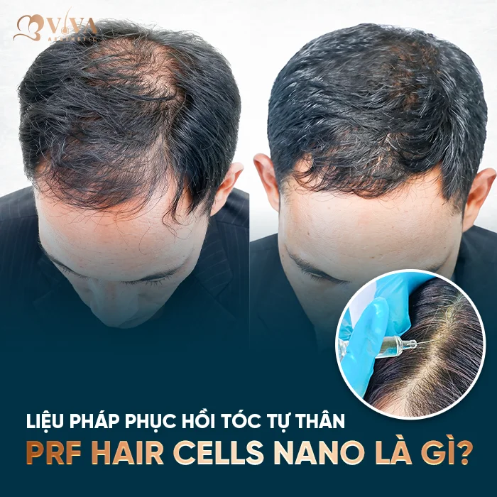 PRF Hair Cells Nano là gì