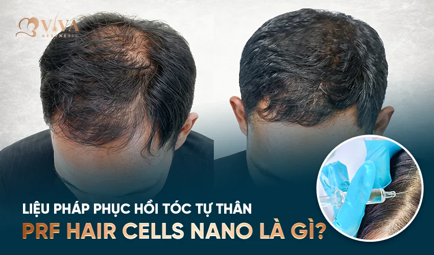 PRF Hair Cells Nano là gì