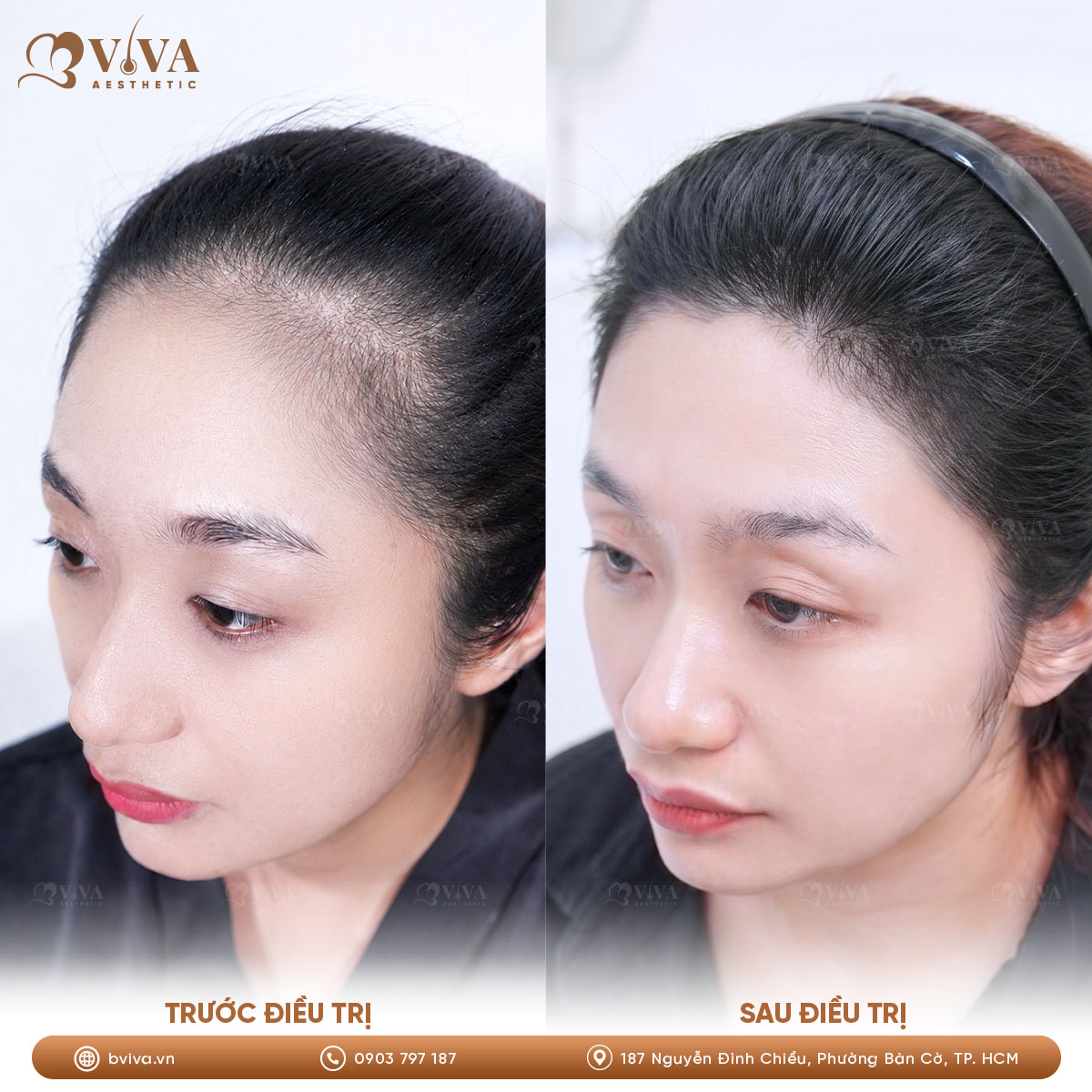 Kết quả trước và sau khi tiêm tăng trưởng SkinGenuity cải thiện tóc thưa tại BVIVA